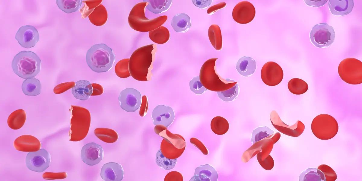 Symptoms and Prevention of Sickle Cell Disease