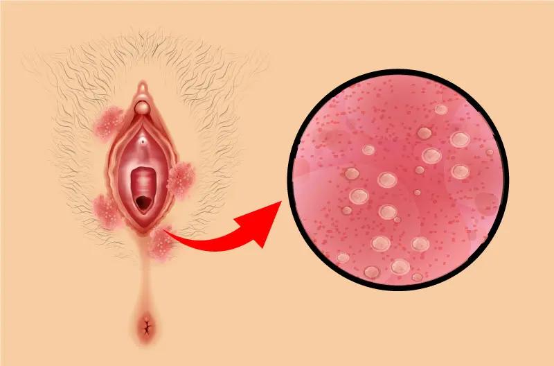 Mycoses vaginales symptômes